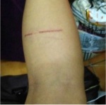 Scratch from Limpy on my leg, my cat in Taipei!